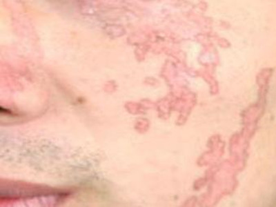长春治疗面部牛皮癣的注意事项